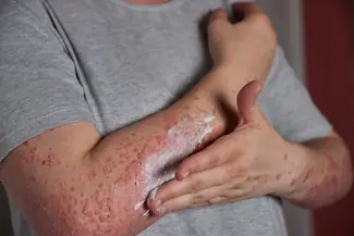 Personne appliquant une crème sur une peau atteinte de psoriasis, illustrant les manifestations cutanées des maladies auto-immunes